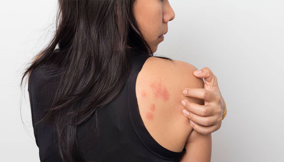 Kopřivka - jak na ni?